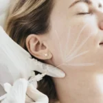 Bioestimulador Radiesse em Fortaleza - Ceará
