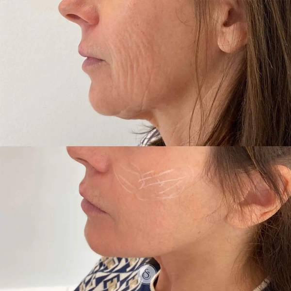Bioestimuladores de Colágeno antes e depois