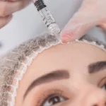 botox - toxina-botulinica - Fortaleza / Ceará