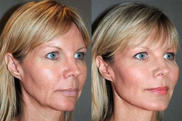 fios pdo antes e depois