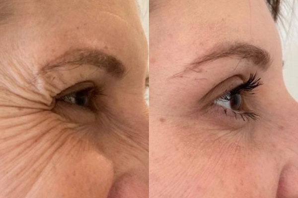 preenchimento com ácido hialurônico antes e depois