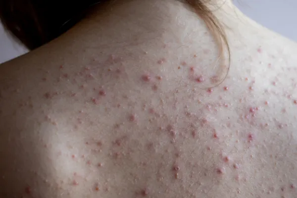 acne hormonal