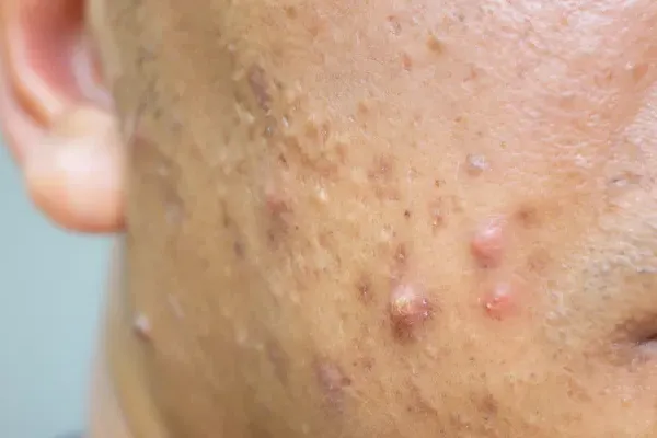 acne nodular e cística