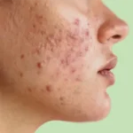 Tratamento para acne em Fortaleza, Ceará