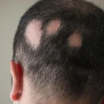 alopecia areata