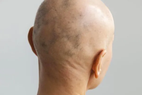 alopecia areata total