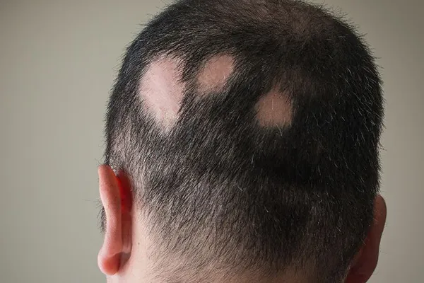 alopecia areata