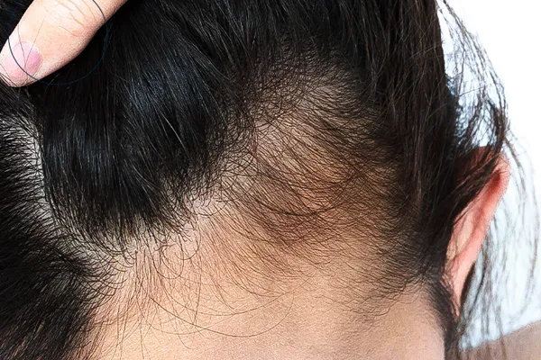alopecia em estágio inicial