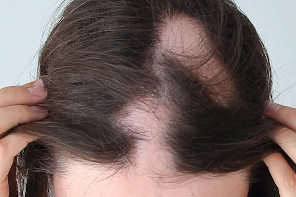 impacto emocional da alopecia areata