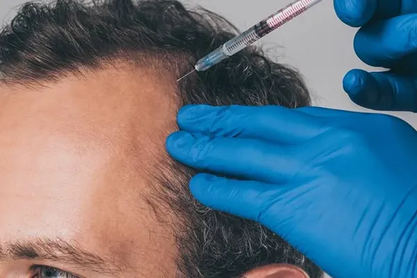 Terapia capilar para calvície