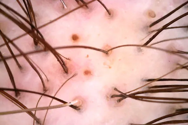 Tricoscopia e diagnóstico capilar na Tricologia
