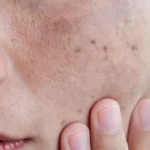 melasma