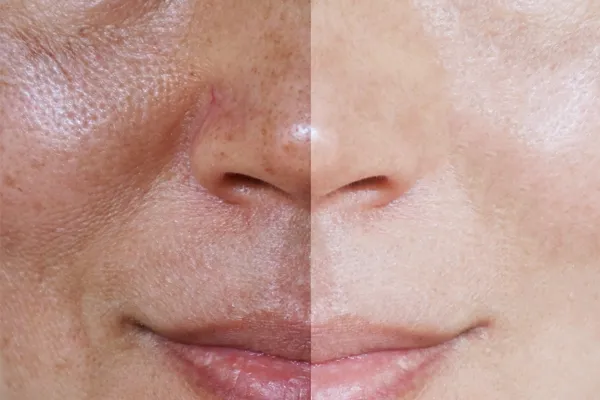 antes e depois do tratamento de melasma