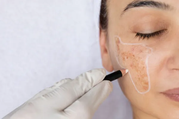 tratamento de melasma em fortaleza