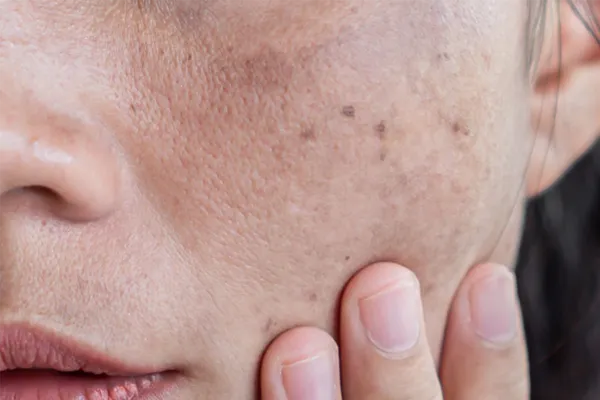 melasma
