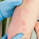 psoriase