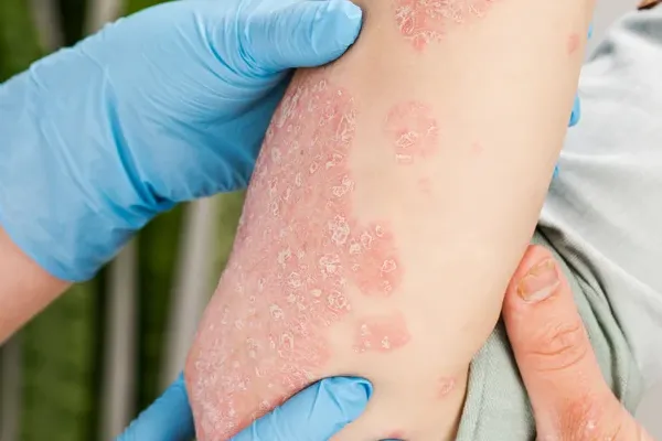 psoriase