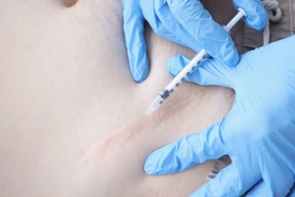 tratamento de cicatrizes com infiltração no dermatologista