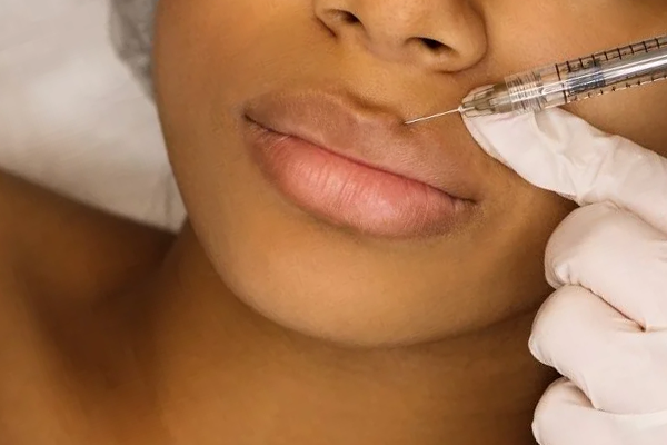 preenchimento dos labios