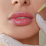 preenchimento facial em fortaleza