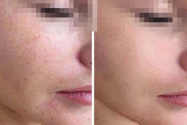 microagulhamento antes e depois