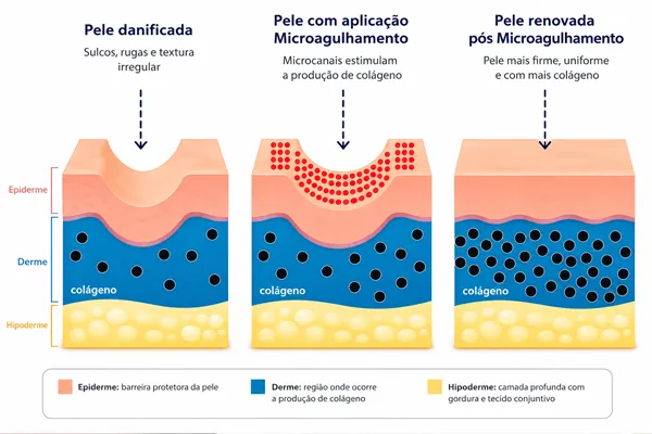 como funciona o microagulhamento