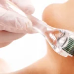 microagulhamento estetica facial fortaleza