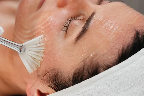 peeling químico para manchas em fortaleza