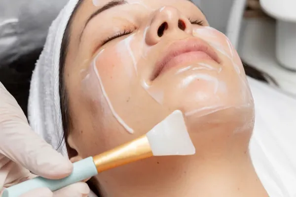 peeling quimico em fortaleza
