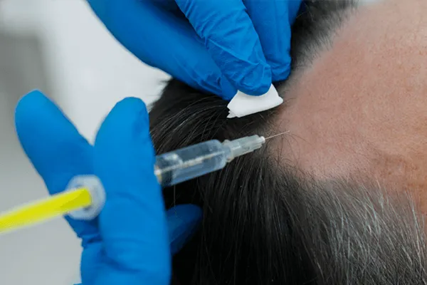 mesoterapia capilar em fortaleza, ceará